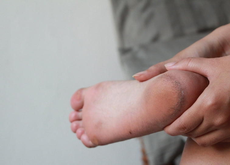Cracked Feet