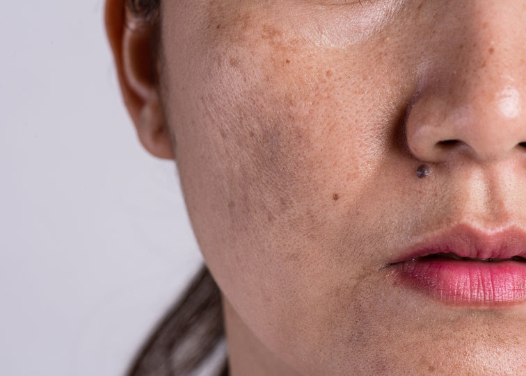 Tackling Melasma with Dr. Brightening Ultra-Potent Facial Serum