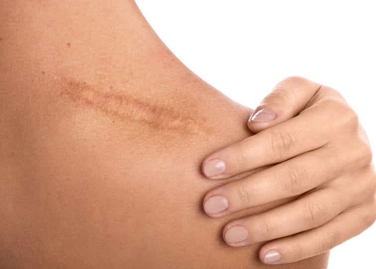 shoulder scar