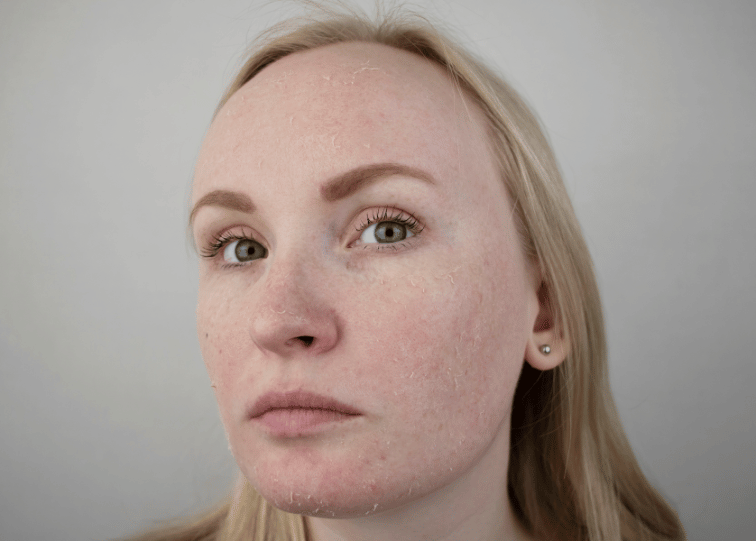 Why Is My Skin So Dry Even When I Moisturize