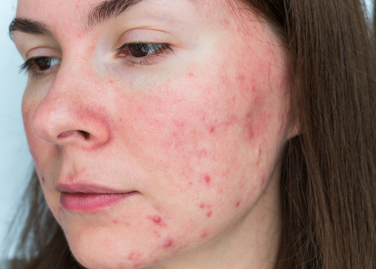 How to Repair Your Skin Barrier